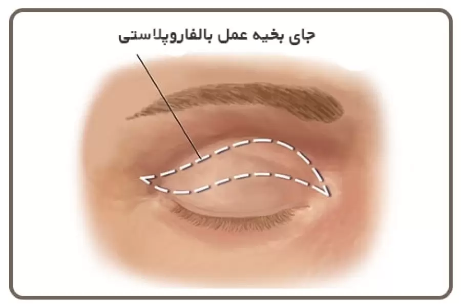 جای بخیه عمل بلفاروپلاستی